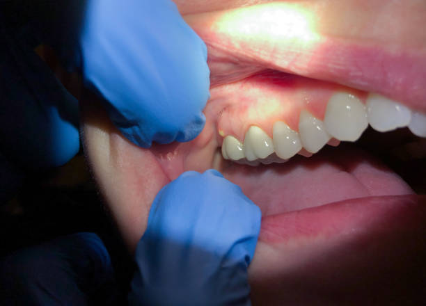 Best Emergency Tooth Extraction in Romancoke, MD