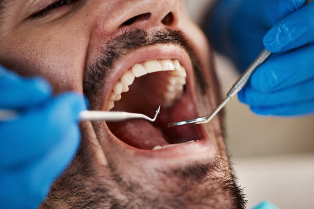 Best Emergency Root Canal Treatment in Romancoke, MD