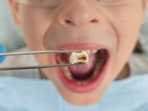Best Emergency Gum Treatment in Romancoke, MD